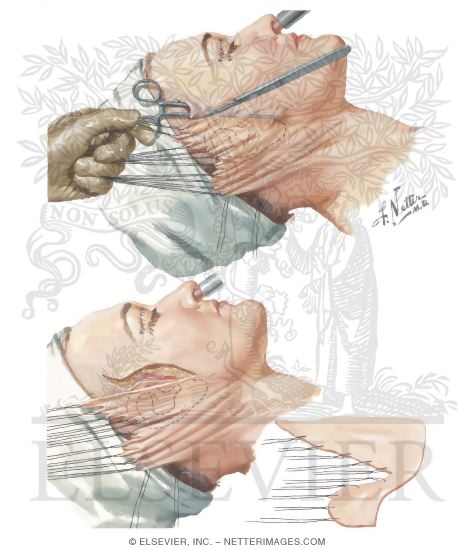 rhytidectomy