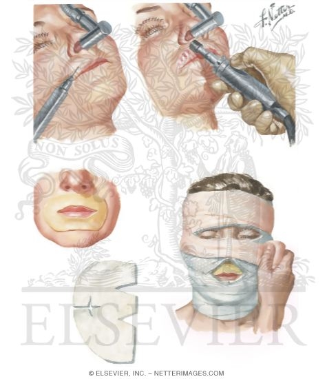 Rhytidectomy (Face Lift): Abrasion of Perieoral Wrinkles