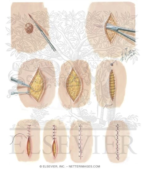 Watermarked preview of unlabeled image: Removal of Skin Tumors