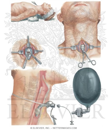 Insertion of Cuff-Type Tracheostomy Tube