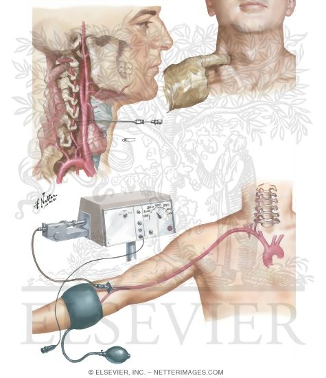 Watermarked preview of unlabeled image: Vertebral Angiography for Visualization of Posterior Cerebral Artery