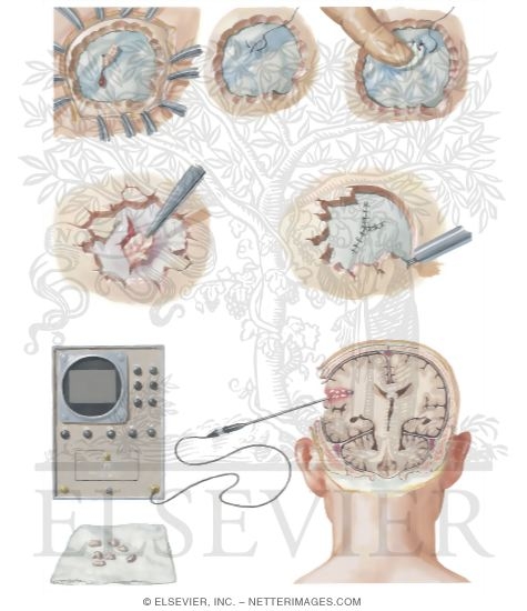 Watermarked preview of unlabeled image: Additional Indications for Early Operations: Sinus Tears, Compound Depressed Fractures, and Penetration Injuries