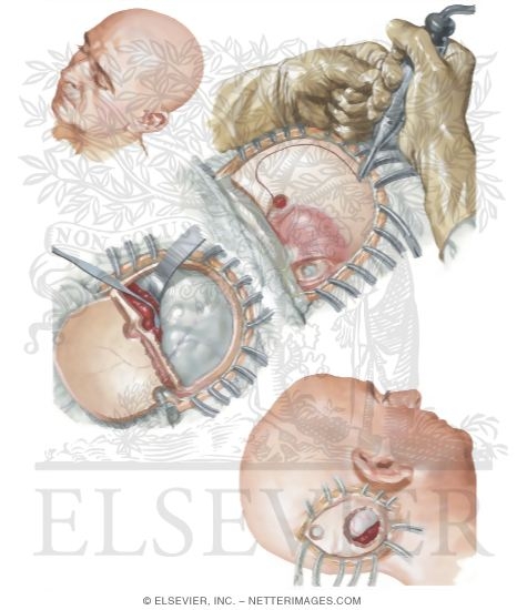 Operative Treatment of Subfrontal and Posterior Fossa Epidural Hematoma