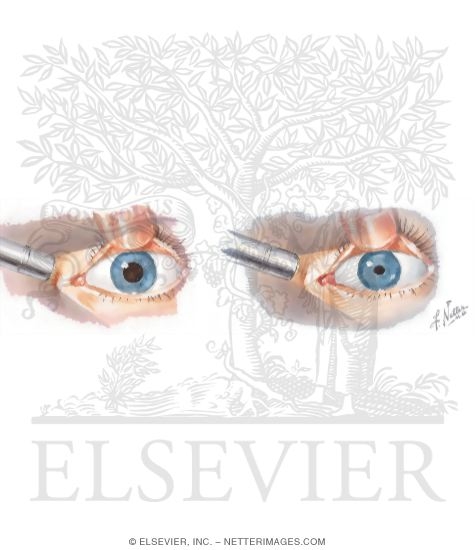 Assessing Pupillary Size and Reaction