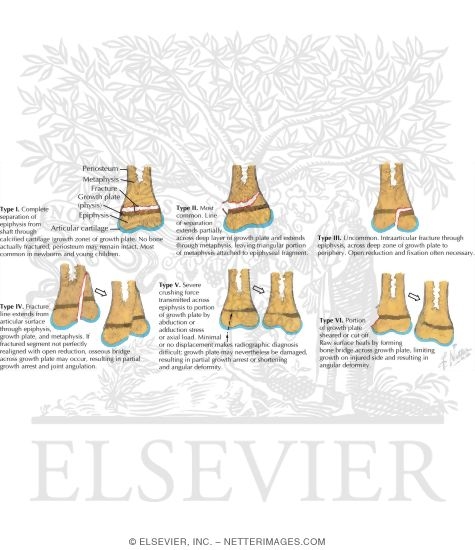 Watermarked preview of labeled image: Injury to Growth Plate (Salter-Harris Classification, Rang Modification)