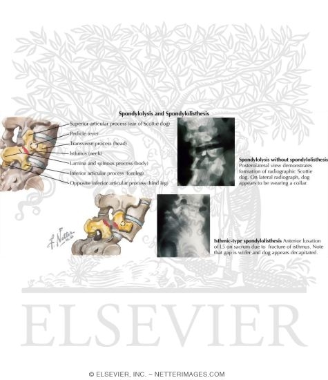 Spondylolysis and Spondylolisthesis
