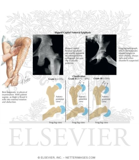 Watermarked preview of labeled image: Slipped Capital Femoral Epiphysis