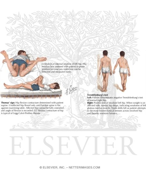 Watermarked preview of labeled image: Physical Examination In Legg-Calve-Perthes Disease