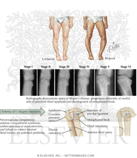 Blount's Disease
Infantile Tibia Vara
