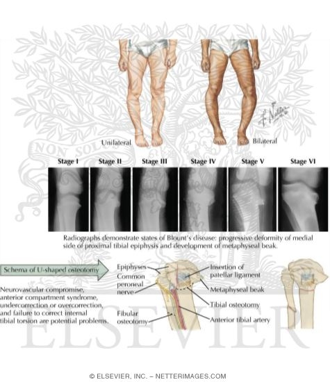 PDF] Tibia vara or Blount's disease: Why an early diagnosis and