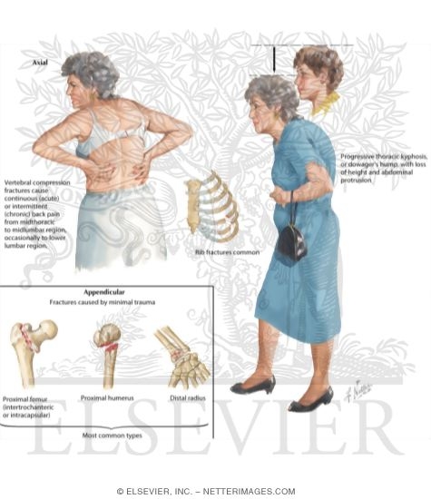 Clinical Manifestations of Osteoporosis