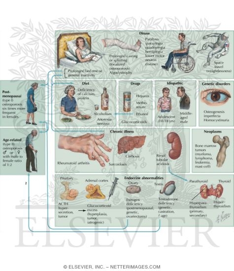 Watermarked preview of labeled image: Causes of Osteoporosis