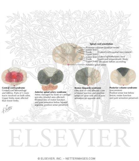 Watermarked preview of labeled image: Cervical Spine Injury: Incomplete Spinal Cord Syndromes