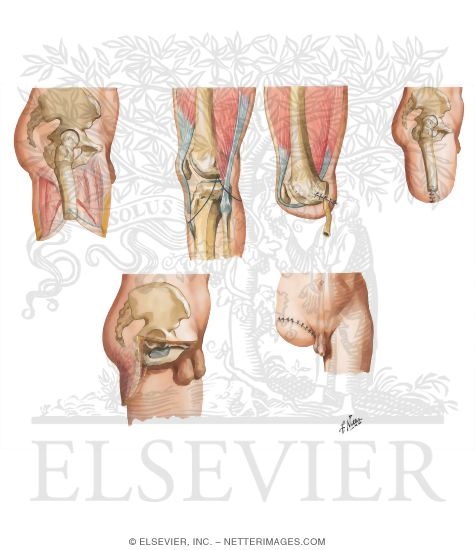 Above Knee Amputation