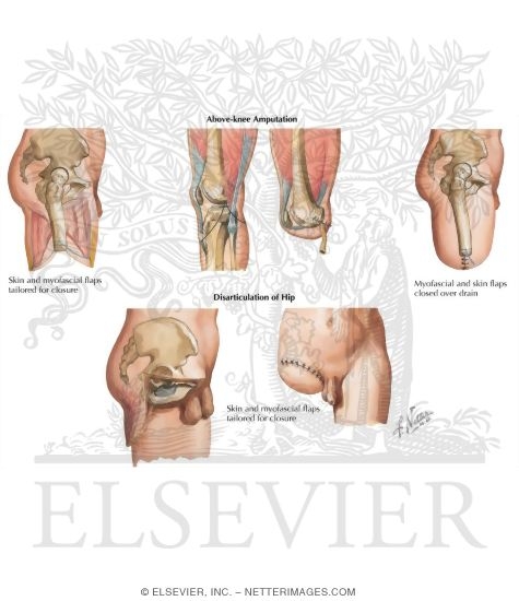 Watermarked preview of labeled image: Above Knee Amputation