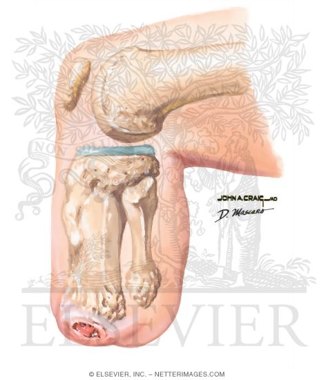 Complications of Amputation