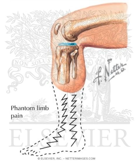 Watermarked preview of labeled image: Complications of Amputation