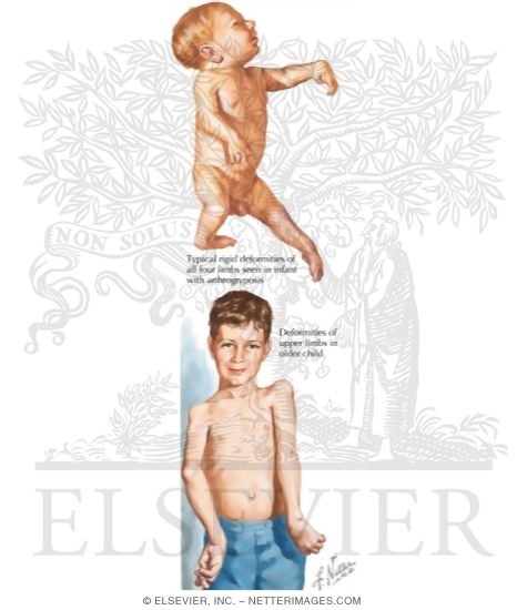 Arthrogryposis Multiplex Congenita