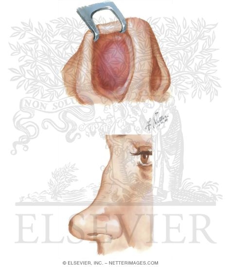 Watermarked preview of unlabeled image: Nasal Fracture