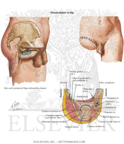 Above-Knee Amputation - Disarticulation at the Hip