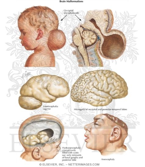 Brain Malformations