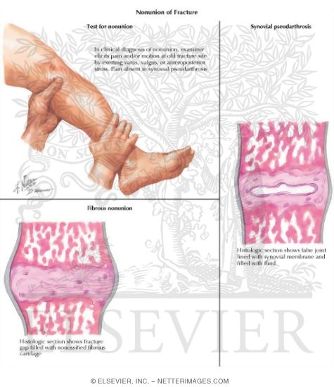 Watermarked preview of labeled image: Nonunion of Fracture