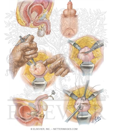 Surgical Approaches Iii Perineal