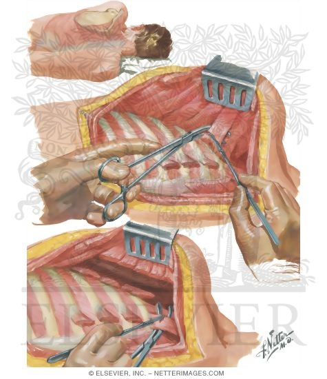 Watermarked preview of unlabeled image: Chest Surgery In Tuberculosis