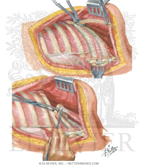 Watermarked preview of unlabeled image: Chest Surgery In Tuberculosis