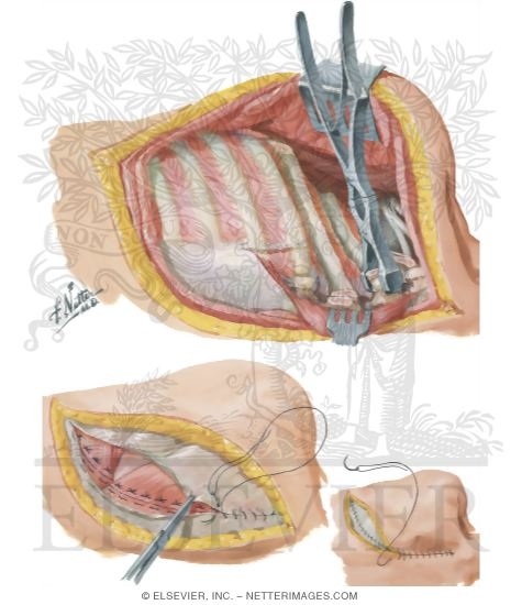 Watermarked preview of unlabeled image: Chest Surgery In Tuberculosis