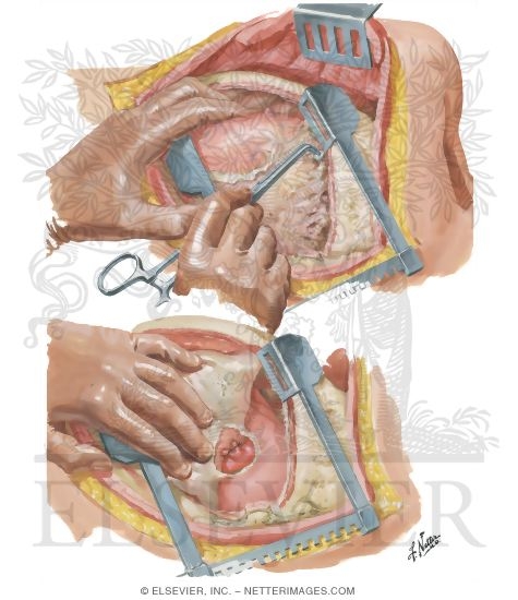 Watermarked preview of unlabeled image: Chest Surgery In Tuberculosis