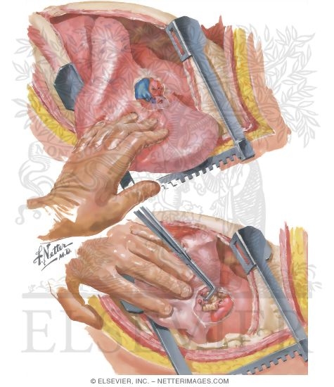 Watermarked preview of unlabeled image: Chest Surgery In Tuberculosis