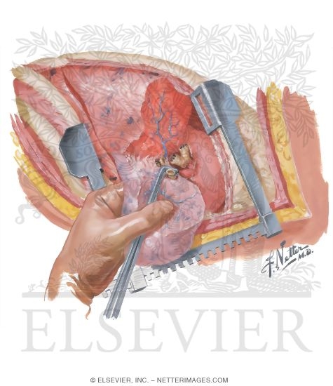 Watermarked preview of unlabeled image: Chest Surgery In Tuberculosis