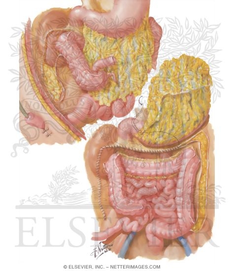 Watermarked preview of unlabeled image: Surgical Treatment of Chronic Ulcerative Colitis: Stage II, Colectomy