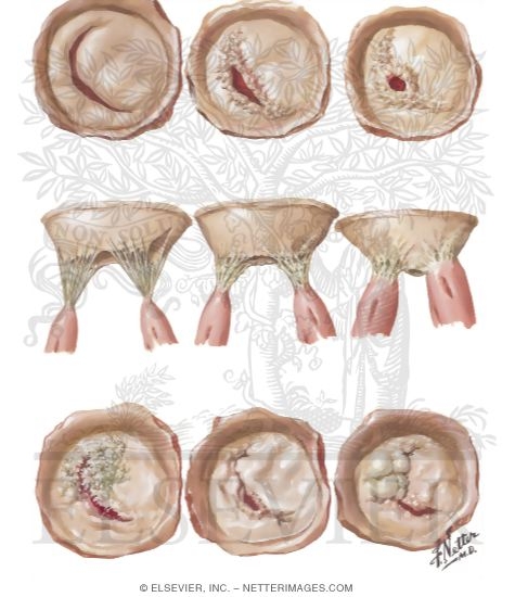 mitral stenosis