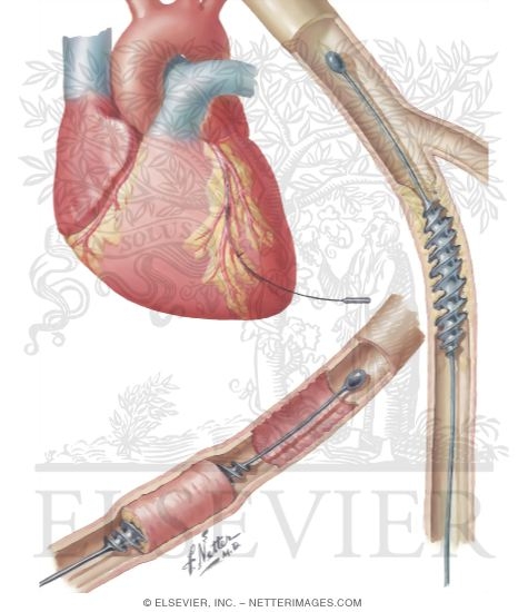 Watermarked preview of unlabeled image: Coronary Artery Stripping