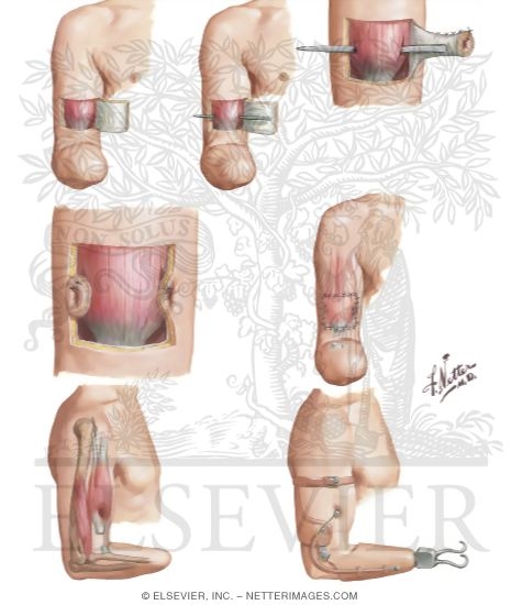 Amputations Of Upper Extremity