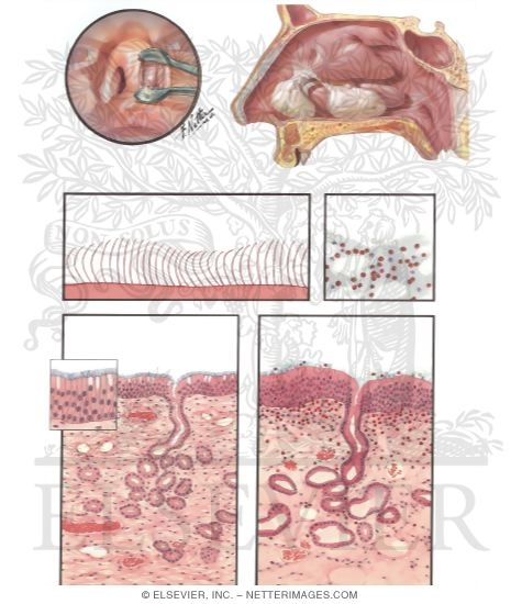 Watermarked preview of unlabeled image: Acute And Chronic Nasal Allergy