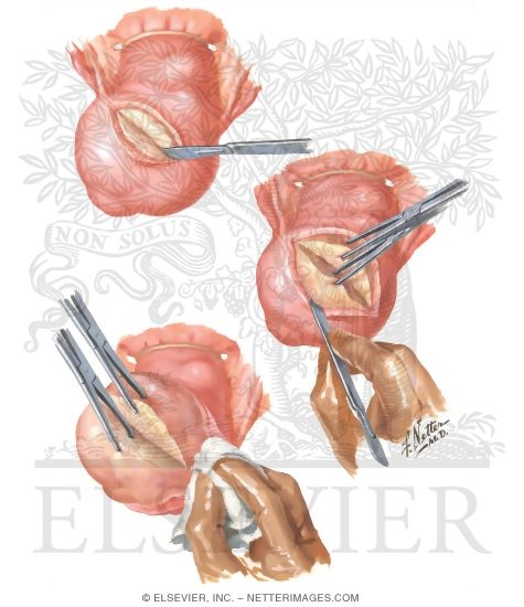 Watermarked preview of unlabeled image: Myomectomy In Treatment Of Infertility