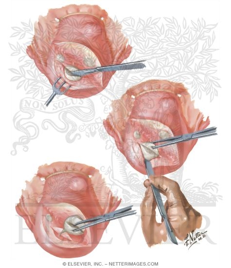 Watermarked preview of unlabeled image: Myomectomy In Treatment Of Infertility