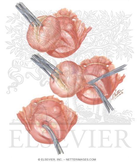 Watermarked preview of unlabeled image: Myomectomy In Treatment Of Infertility