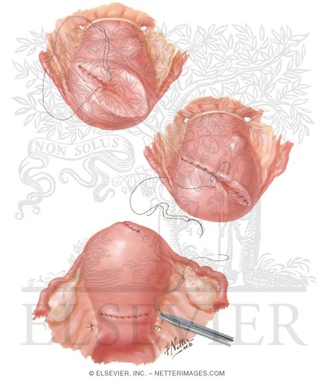 Watermarked preview of unlabeled image: Myomectomy In Treatment Of Infertility