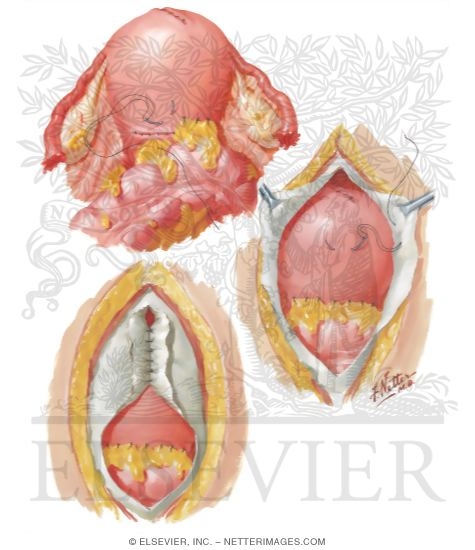 Watermarked preview of unlabeled image: Myomectomy In Treatment Of Infertility