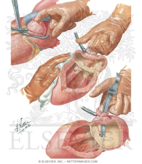 Watermarked preview of unlabeled image: Left-Sided Approach To Mitral Stenosis