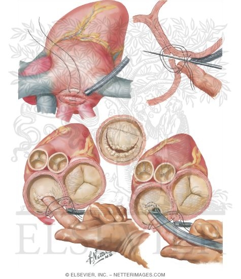 Watermarked preview of unlabeled image: Neostrophingic Mobilization, Right-Sided Approach