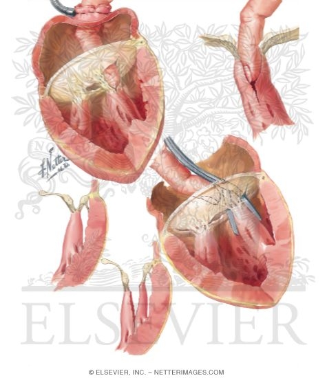 Watermarked preview of unlabeled image: Subvalvular Stenosis