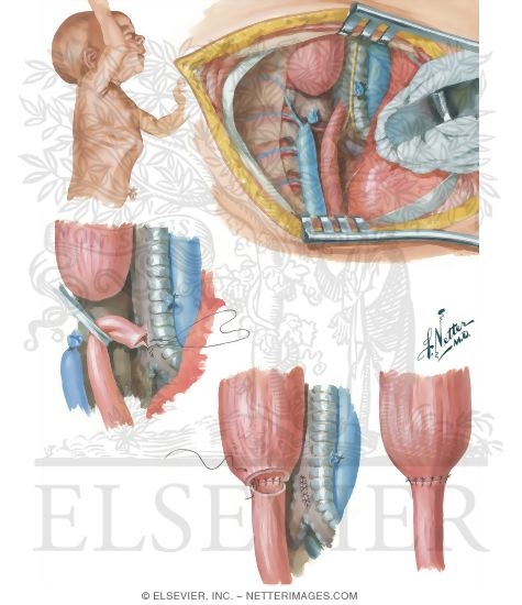 Watermarked preview of unlabeled image: Transpleural Approach To Atresia Of Esophagus