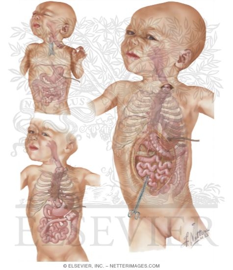 Watermarked preview of unlabeled image: Transpleural Approach To Atresia Of Esophagus