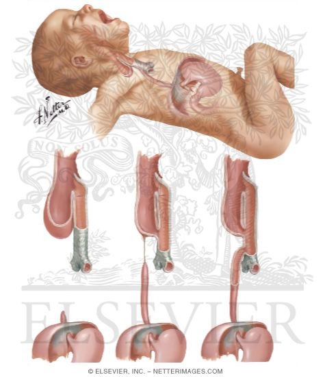 Watermarked preview of unlabeled image: Various Forms Of Atresia Of Esophagus