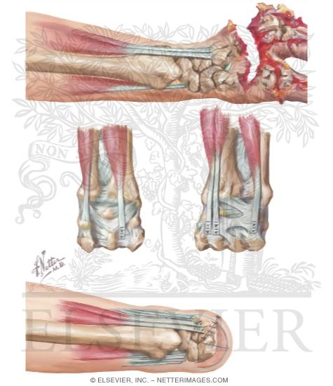 Watermarked preview of unlabeled image: Amputations Of Upper Extremity